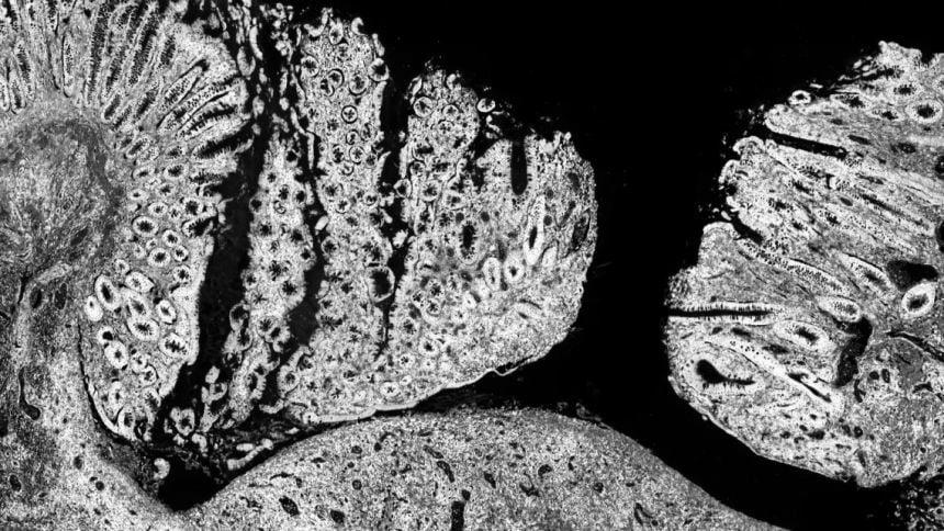 Spatial transcriptomics image showing a partially epithelialised fistula tract